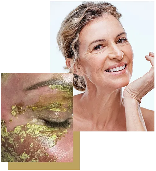 Prima e dopo peeling al fenolo eseguito dalla dottoressa, con applicazione della soluzione sul viso e risultato di pelle ringiovanita e luminosa