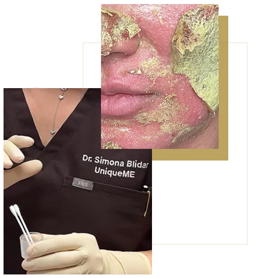 Trattamento viso con peeling al fenolo eseguito dalla dottoressa Simona Blidar durante la procedura estetica